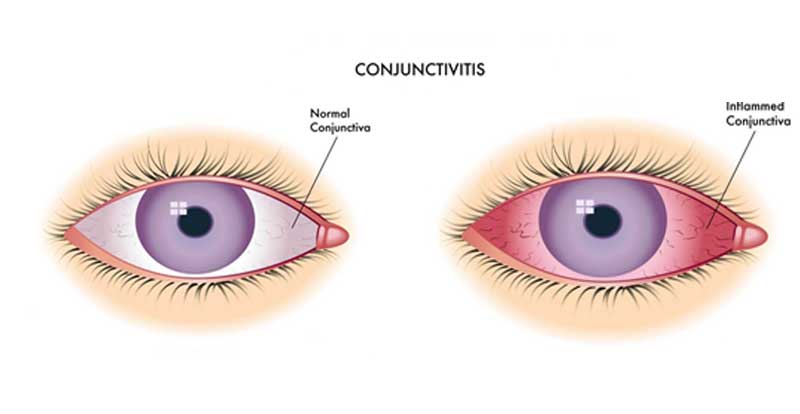 FDA approves Use of Omidria during Cataract Surgery